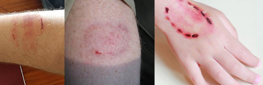 कुत्ते ही नहीं बन्दर के काटने से भी रेबीज हो सकता है