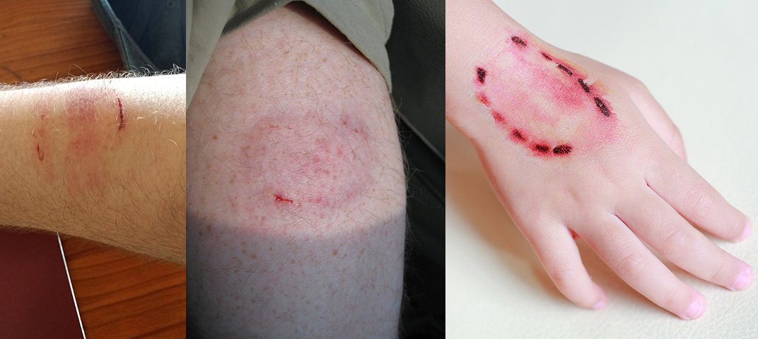 कुत्ते ही नहीं बन्दर के काटने से भी रेबीज हो सकता है